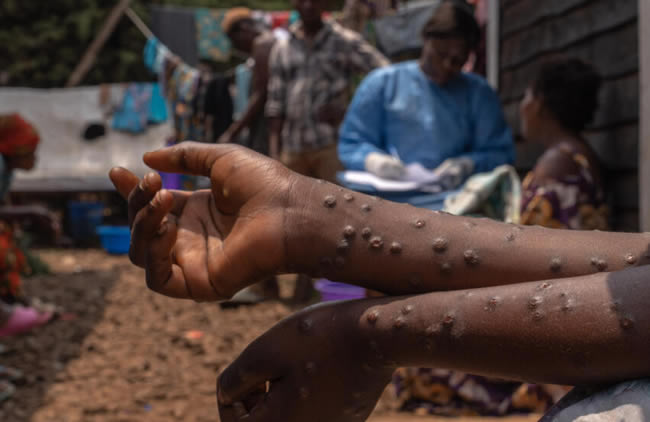 DRC launches first mpox vaccination drive in efforts to curb outbreak